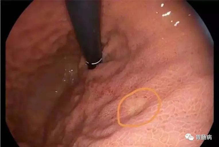 醫(yī)生總結(jié)了3位年輕胃癌患者的病例：30歲不到的他們到底干啥了？