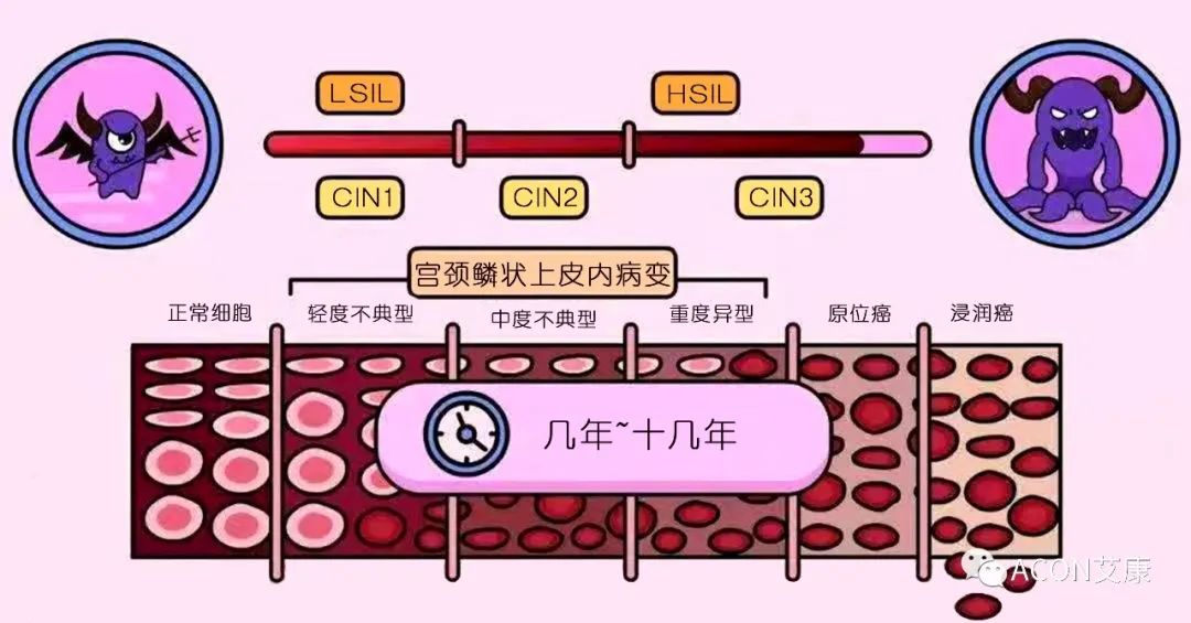 HPV轉(zhuǎn)陰其實很簡單， 女性必知的宮頸癌真相
